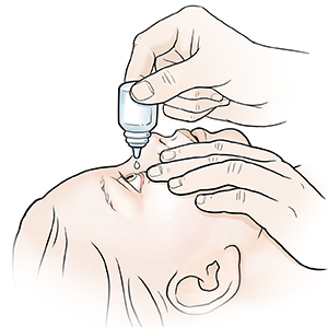 Child's head tipped back and eyedrops being put in child's eye.