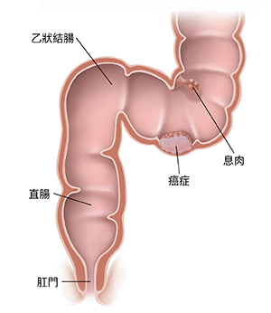 顯示癌症和息肉的乙狀結腸、直腸和肛門剖面圖。