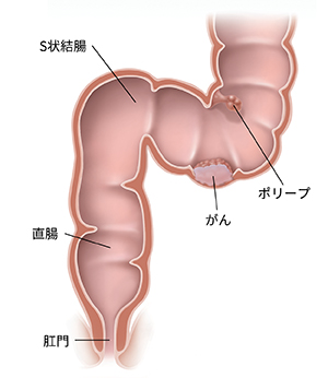 がんとポリープを示す S 状結腸、直腸、肛門の断面図。